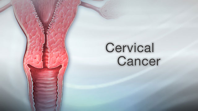 <div class=media-desc><strong>Cervical cancer</strong><p>Worldwide, cervical cancer is the third most common type of cancer in women. Luckily, it's much less common in the United States due to women receiving recommended routine Pap smears, the test designed to find cervical cancer sometimes even before abnormal cells turn to cancer. Cervical cancer starts in the cells on the surface of the cervix, the lower portion of the uterus. There are two types of cells on the surface of the cervix, squamous and columnar. Most cervical cancers come from these squamous cells. The cancer usually starts very slowly as a condition called dysplasia. This precancerous condition can be detected by Pap smear and is 100% treatable. Undetected, precancerous changes can develop into cervical cancer and spread to the bladder, intestines, lungs, and liver. It can take years for these precancerous changes to turn into cervical cancer. However, patients with cervical cancer do not usually have problems until the cancer is advanced and has spread. Most of the time, early cervical cancer has no symptoms. Symptoms of advanced cancer may include back pain, bone fractures, fatigue, heavy vaginal bleeding, urine leakage, leg pain, loss of appetite, and pelvic pain. If after having a Pap smear, the doctor finds abnormal changes on the cervix, a colposcopy can be ordered. Using a light and a low-powered microscope, the doctor will view the cervix under magnification. The doctor may remove pieces of tissue, called a biopsy, and send the sample to a laboratory for testing. If the woman is diagnosed with cervical cancer, the doctor will order more tests to determine how far the cancer has spread. This is called Staging. Treatment will depend on the stage of the cancer, the size and shape of the tumor, the woman's age and general health, and her desire to have children in the future. Early cervical cancer can be treated with surgery just to remove abnormal tissue, freeze abnormal cells, or burn abnormal tissue. Treatment for more advanced cervical cancer may include radical hysterectomy, removal of the uterus and much of the surrounding tissue, including lymph nodes and the upper part of the vagina. Radiation may be used to treat cancer that has spread beyond the pelvis, or if cancer returns. The woman may also have chemotherapy to kill cancer cells. Almost all cervical cancers are caused by human papilloma virus, or HPV. This common virus is spread through sexual intercourse. HPV vaccines can prevent infection against the two types of HPV responsible for about 70% of cervical cancer. Practicing safe sex also reduces the risk of getting HPV. But, keep in mind most women diagnosed with cervical cancer have not had their regular Pap smears. Because Pap smears can find precancerous growths that are 100% treatable, it's very important for women to get Pap smears at regular intervals.</p></div>