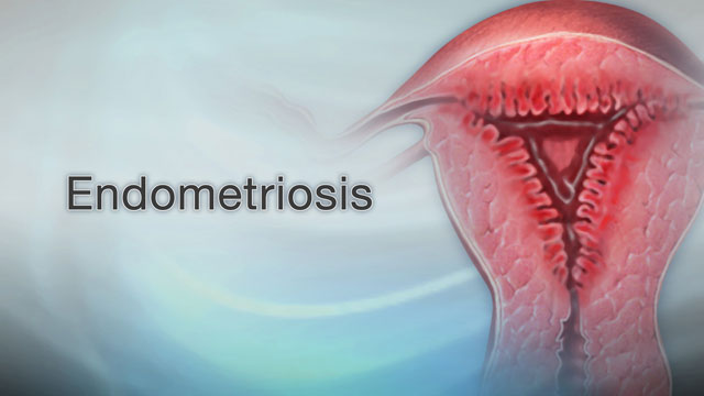 <div class=media-desc><strong>Endometriosis</strong><p>A common gynecological problem in women occurs when cells that are supposed to form in the uterus of a woman, attach themselves to tissue in other places of the body, causing pain, irregular bleeding, and problems with getting pregnant, or infertility. Let's talk about endometriosis in a little more detail. Every month, a woman's ovaries produce hormones that tell the cells lining the uterus, or womb, to swell and thicken. The body removes these extra cells from the womb lining, or endometrium, when you get your period. But if these cells, called endometrial cells, implant and grow outside the uterus, endometriosis results. The growths are called endometrial tissue implants. Women with endometriosis typically have tissue implants on the ovaries, or bowel, rectum, bladder, or on the lining of the pelvic area. We don't know what causes endometriosis. One theory is that the endometrial cells that shed when you get your period travel backwards through the fallopian tubes into the pelvis, where they implant and grow. This is called retrograde menstruation. This backward menstrual flow occurs in many women, but many think the immune system may also be different in women with endometriosis. Symptoms of endometriosis include painful periods, pain in your lower belly before and during menstruation, cramps before and during menstruation, pain during sex, painful bowel movements, as well as pelvic or lower back pain. To treat endometriosis...The goal of treatment is to improve pelvic pain, reduce pelvic masses, or improve fertility. If you have mild symptoms and do not want to have children, you may choose to have regular exams every 6 to 12 months so your doctor can make sure the disease isn't getting worse. Treatment options also include pain medicines, hormone medicines to stop the disease from getting worse, or surgery to remove the area of endometriosis or even the entire uterus and ovaries if you have severe pain that does not get better with other treatments. Hormone therapy doesn't cure endometriosis, but it can relieve some or all of your symptoms. Unfortunately, removal of the uterus, fallopian tubes, and both ovaries may eliminate symptoms, but it also eliminates fertility. A combination of limited surgery and assisted reproduction techniques may improve fertility. So, if you have any questions about endometriosis, please see your doctor.</p></div>