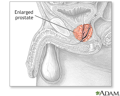 Shemale Prostate