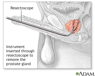 Shemale Prostate