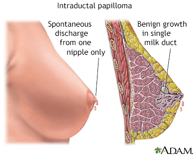 Nipple Discharge Hunterdon Breast Surgery Center