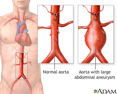 cancer in abdominal aorta