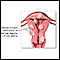 <div class=media-desc><strong>Fibroid tumors</strong><p>Fibroid tumors may not need to be removed if they are not causing pain, bleeding excessively, or growing rapidly. </p></div>